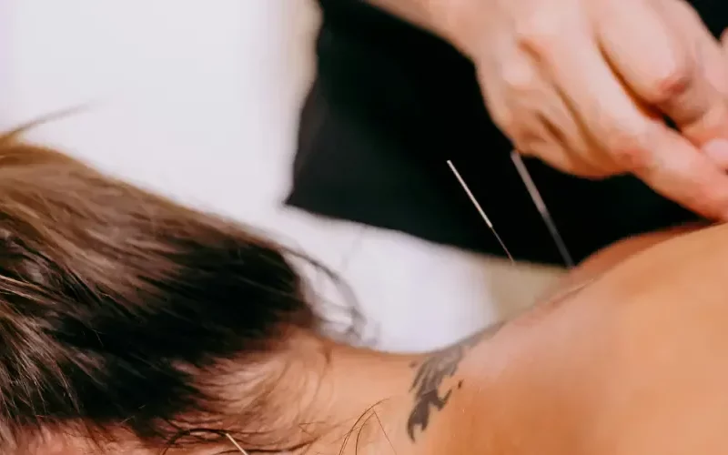 Dry Needling